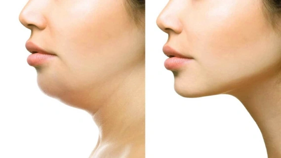 Chin Extension Surgery