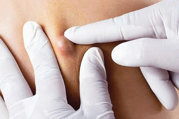 Skin Tag  and Cyst Removal in Navi Mumbai