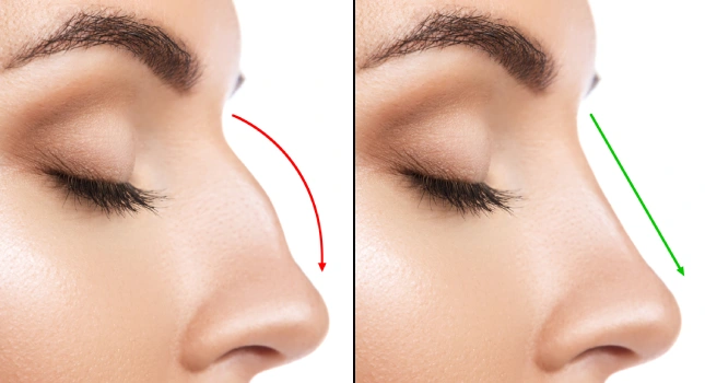 Get Rid of Under-Eye Puffiness with Eye Bag Removal Surgery