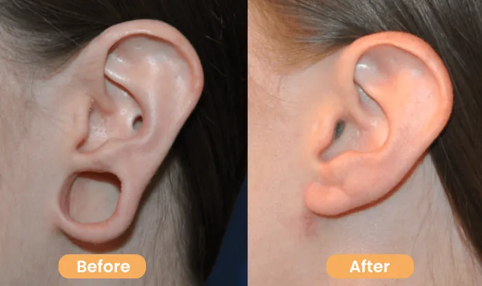 Ear Lobe Repair: Everything You Need to Know