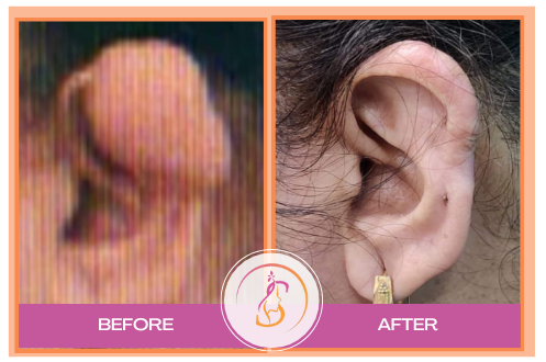 Ear Reconstruction