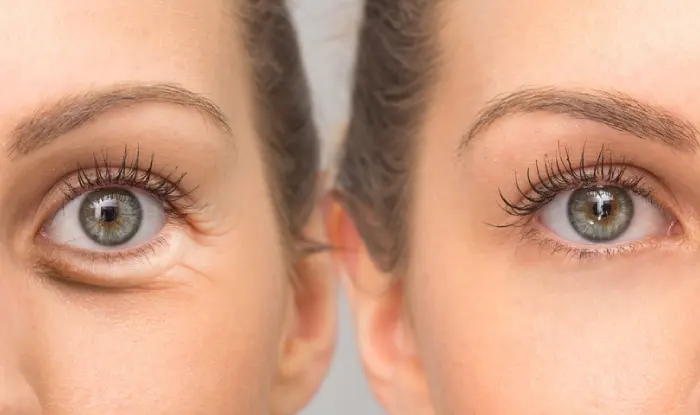 Get Rid of Under-Eye Puffiness with Eye Bag Removal Surgery