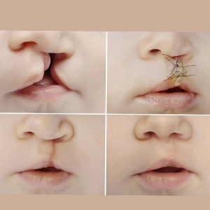 Cleft lip/palate Repair