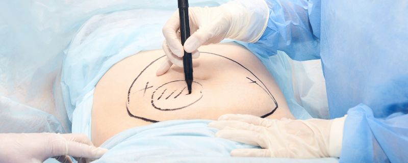 liposuction treatment in navi mumbai