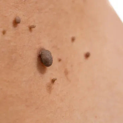 Mole removal in Navi Mumbai