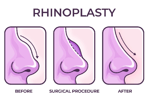 Rhinoplasty Surgery