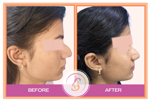 Rhinoplasty