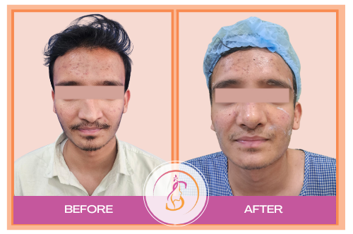 Rhinoplasty